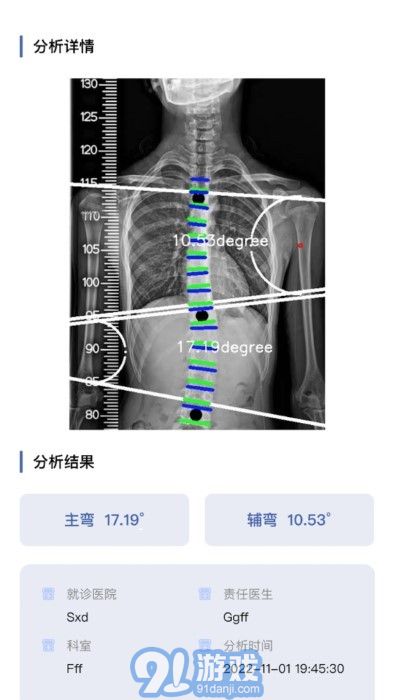 cobb角測(cè)量分析平臺(tái)3